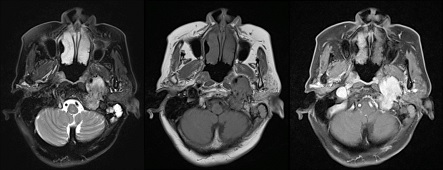 Fig 3. MRI (T2W, T1W, T1W post-contrast)